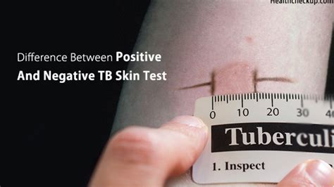 tb test what to expect